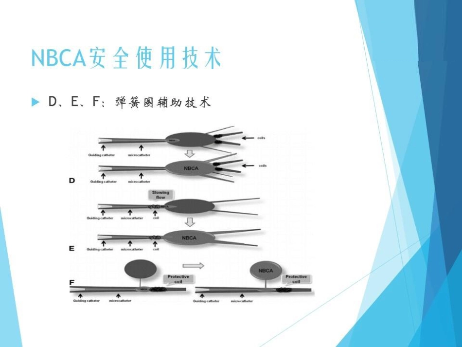 NBCA胶在急诊出血介入治疗中的应用_第10页