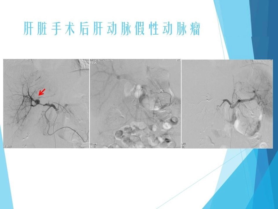 NBCA胶在急诊出血介入治疗中的应用_第12页