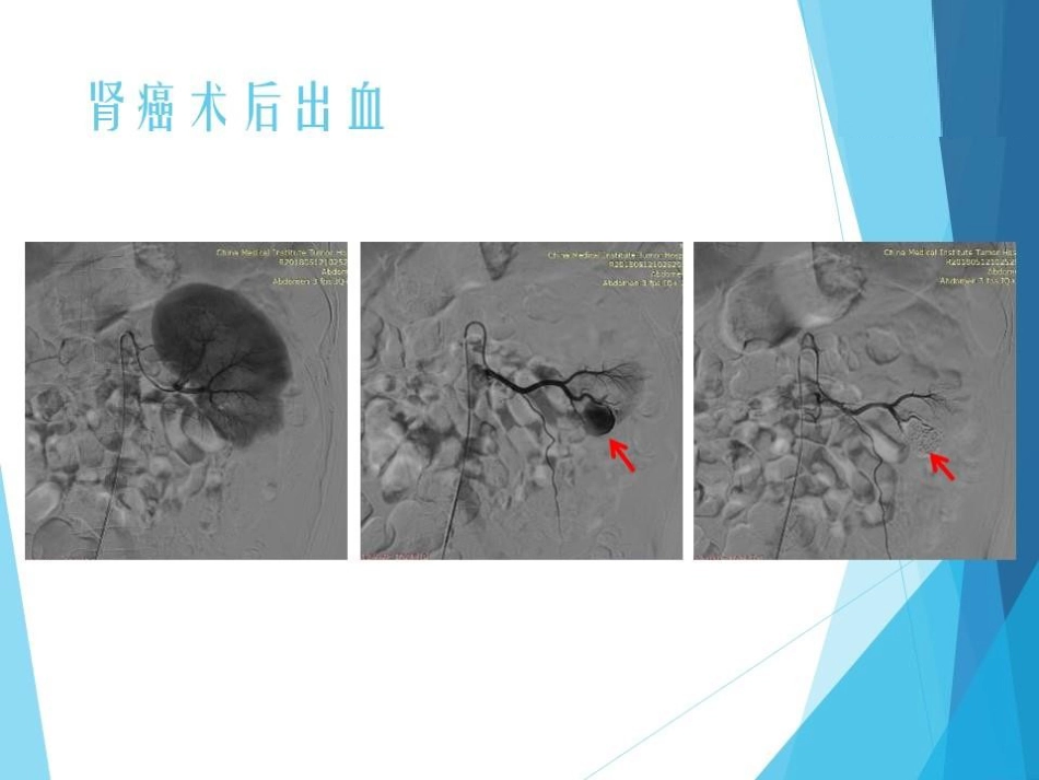 NBCA胶在急诊出血介入治疗中的应用_第14页