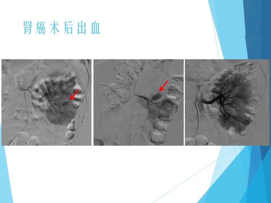 NBCA胶在急诊出血介入治疗中的应用_第15页