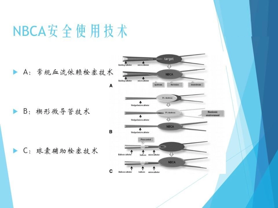 NBCA胶在急诊出血介入治疗中的应用_第9页