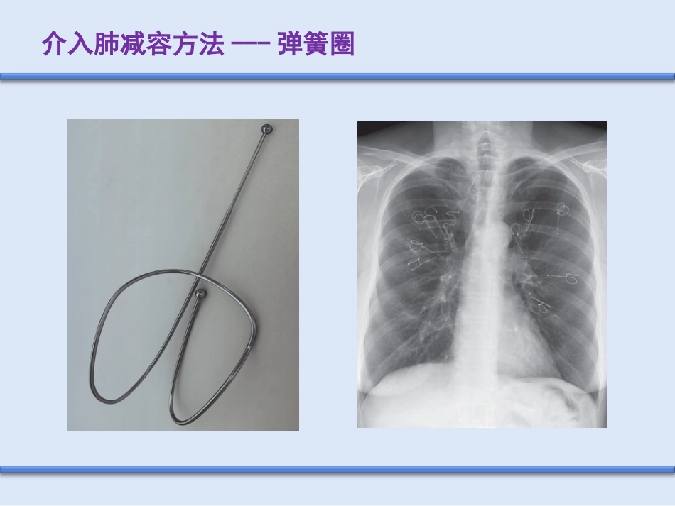 COPD介入治疗_第3页