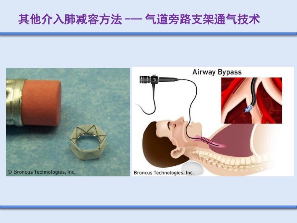 COPD介入治疗_第4页