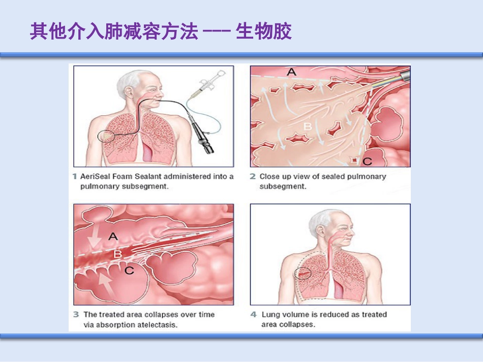 COPD介入治疗_第5页
