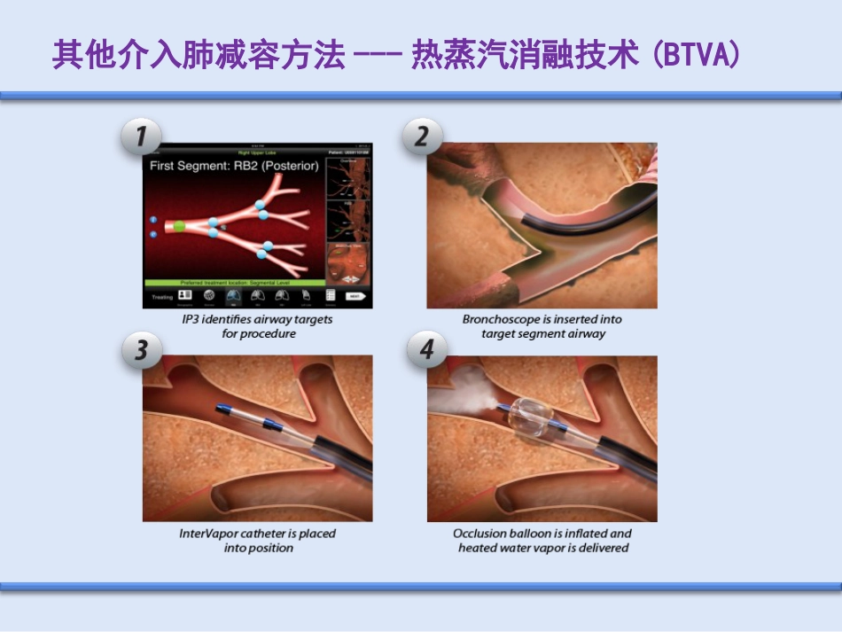 COPD介入治疗_第6页