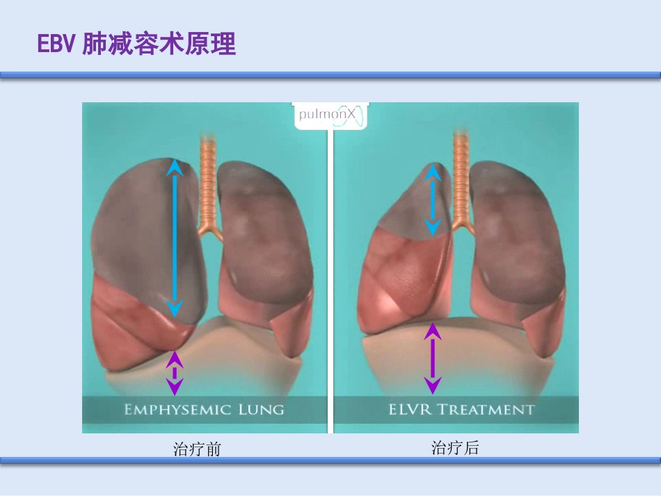 COPD介入治疗_第9页