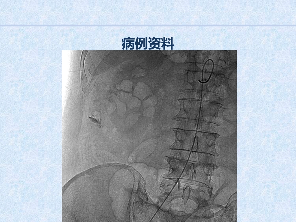 急诊介入消化道出血病例汇报_第11页