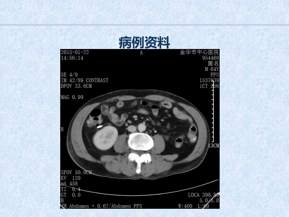急诊介入消化道出血病例汇报_第13页