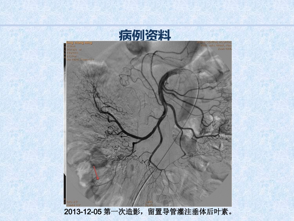 急诊介入消化道出血病例汇报_第4页