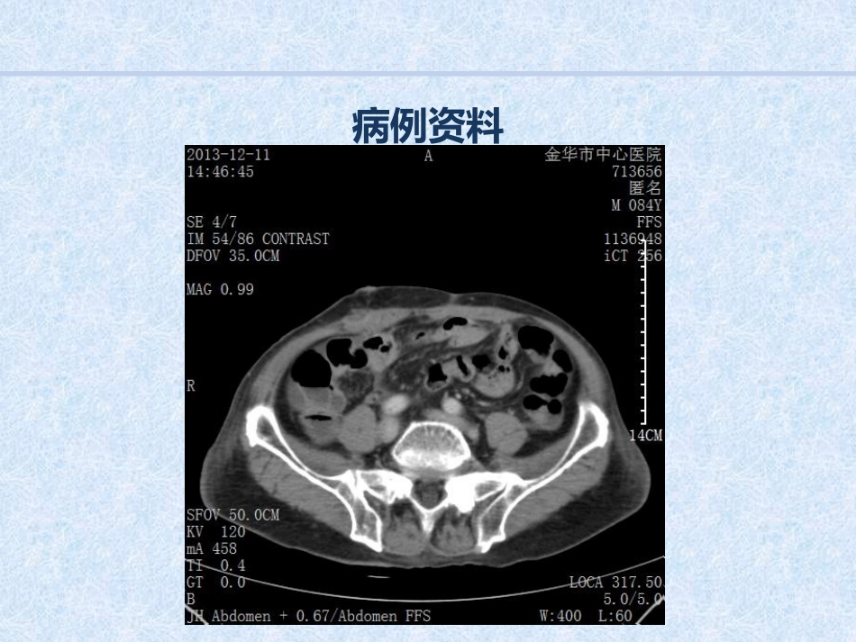 急诊介入消化道出血病例汇报_第7页