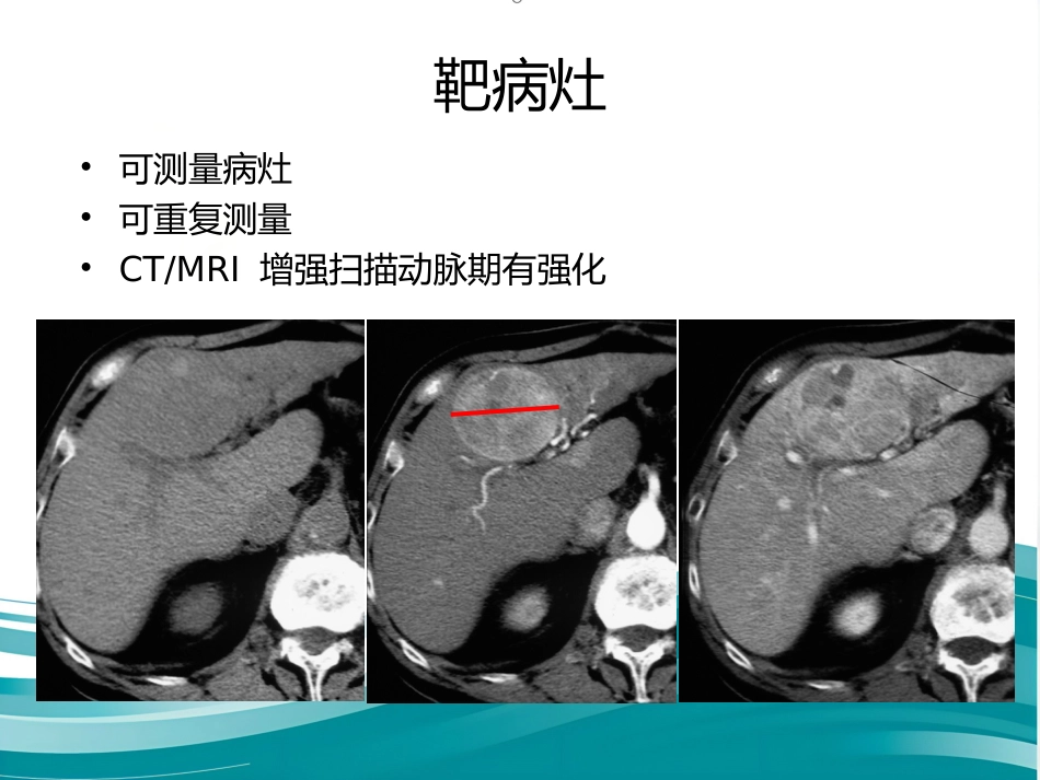 肝癌分期及mRECIST_第15页