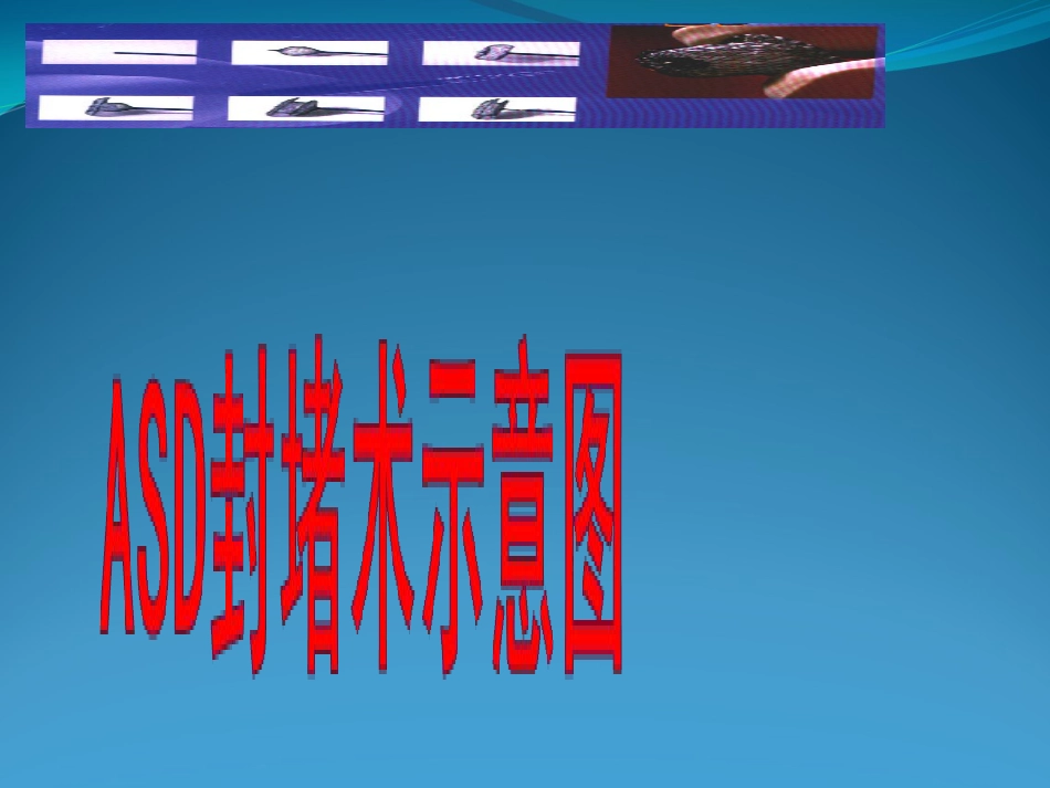 不常用心脏介入治疗_第14页