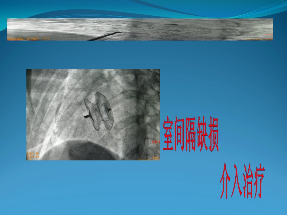 不常用心脏介入治疗_第15页