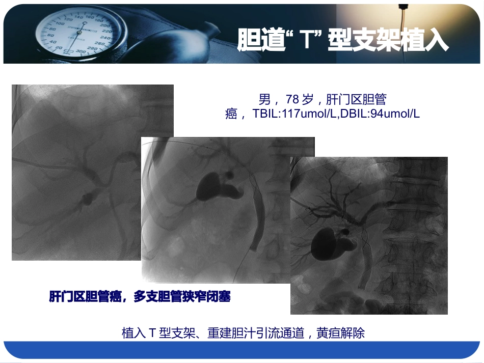 恶性胆道综合介入治疗_第10页