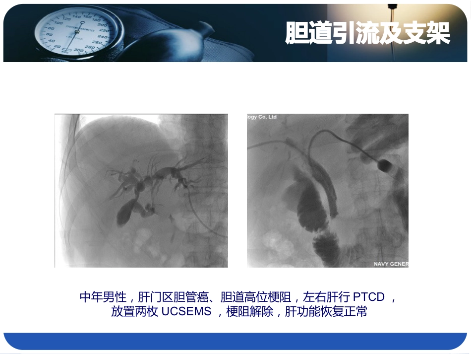 恶性胆道综合介入治疗_第11页