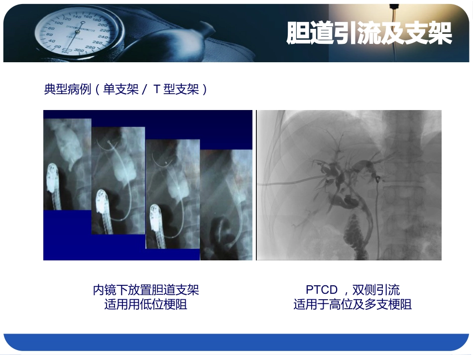 恶性胆道综合介入治疗_第9页