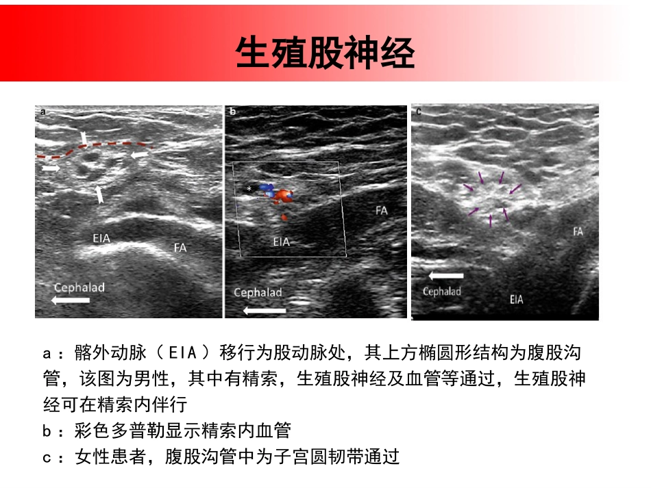 超声引导下盆腔疼痛的介入治疗_第15页