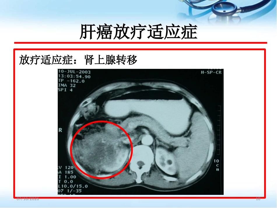 肝癌的放射治疗ppt参考课件_第10页