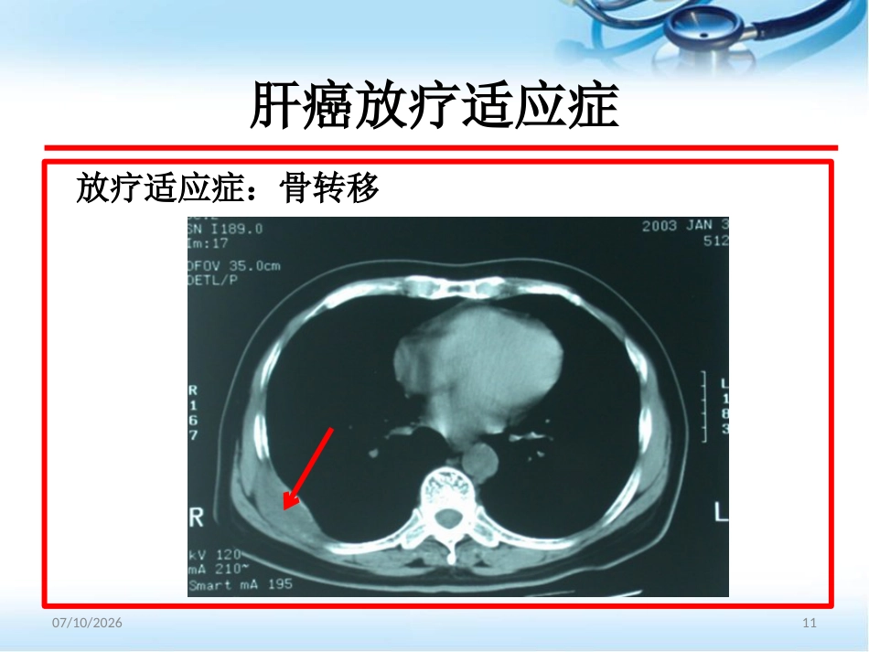 肝癌的放射治疗ppt参考课件_第11页