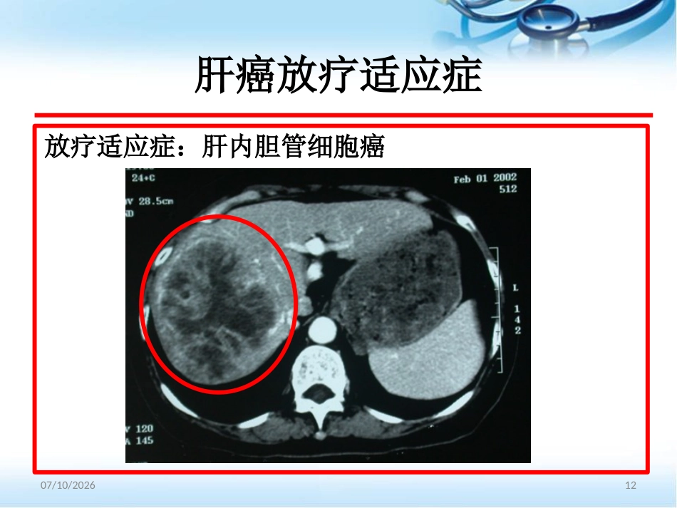 肝癌的放射治疗ppt参考课件_第12页