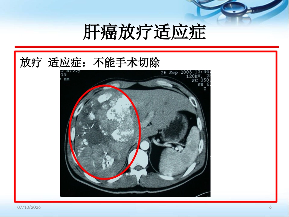 肝癌的放射治疗ppt参考课件_第6页