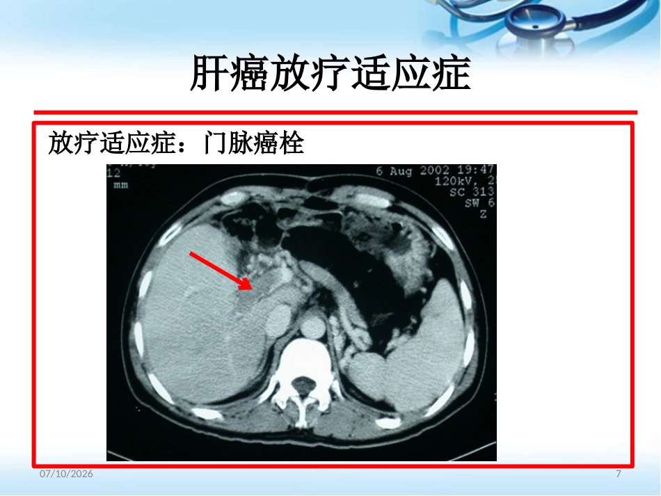 肝癌的放射治疗ppt参考课件_第7页