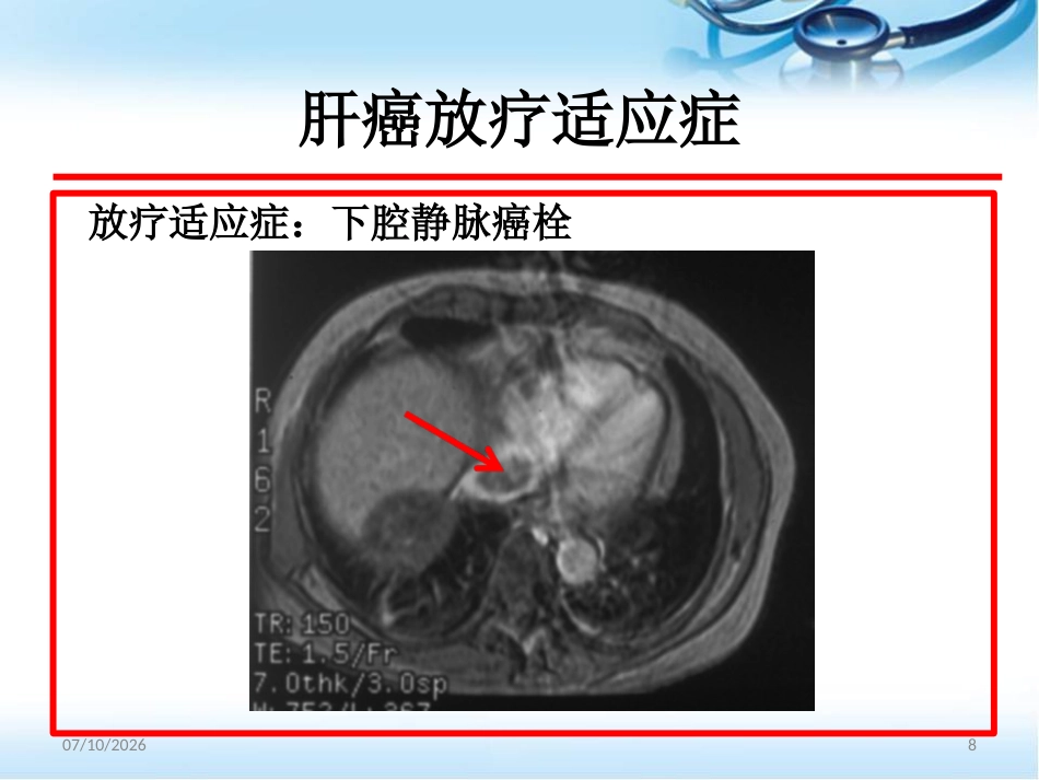 肝癌的放射治疗ppt参考课件_第8页