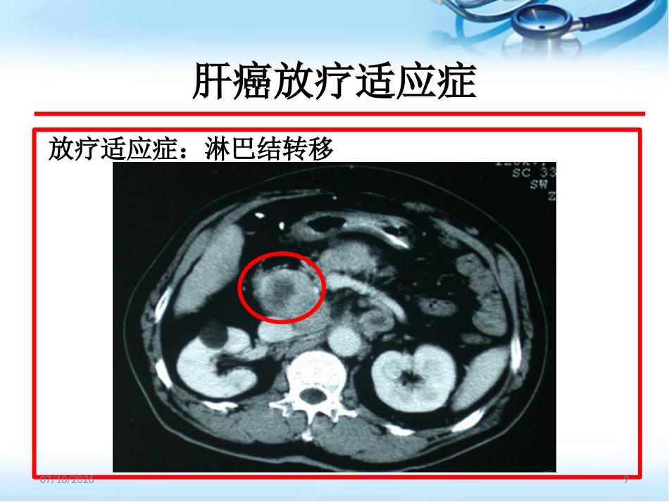 肝癌的放射治疗ppt参考课件_第9页