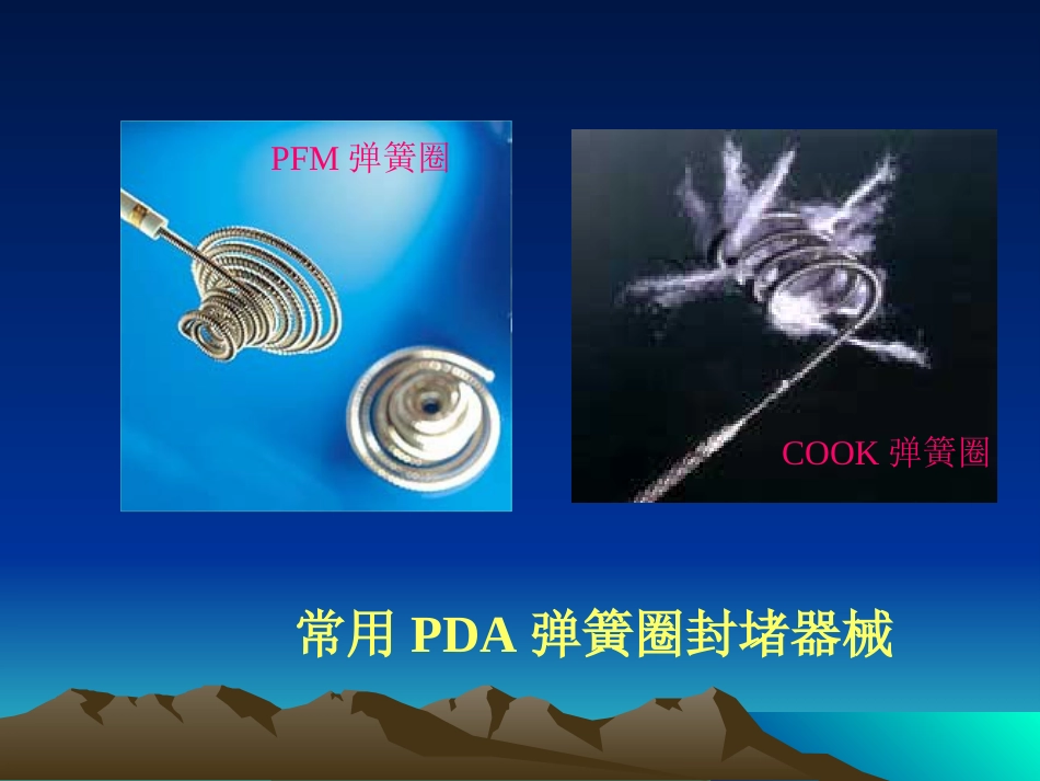 常见先天性心脏病介入治疗_第15页