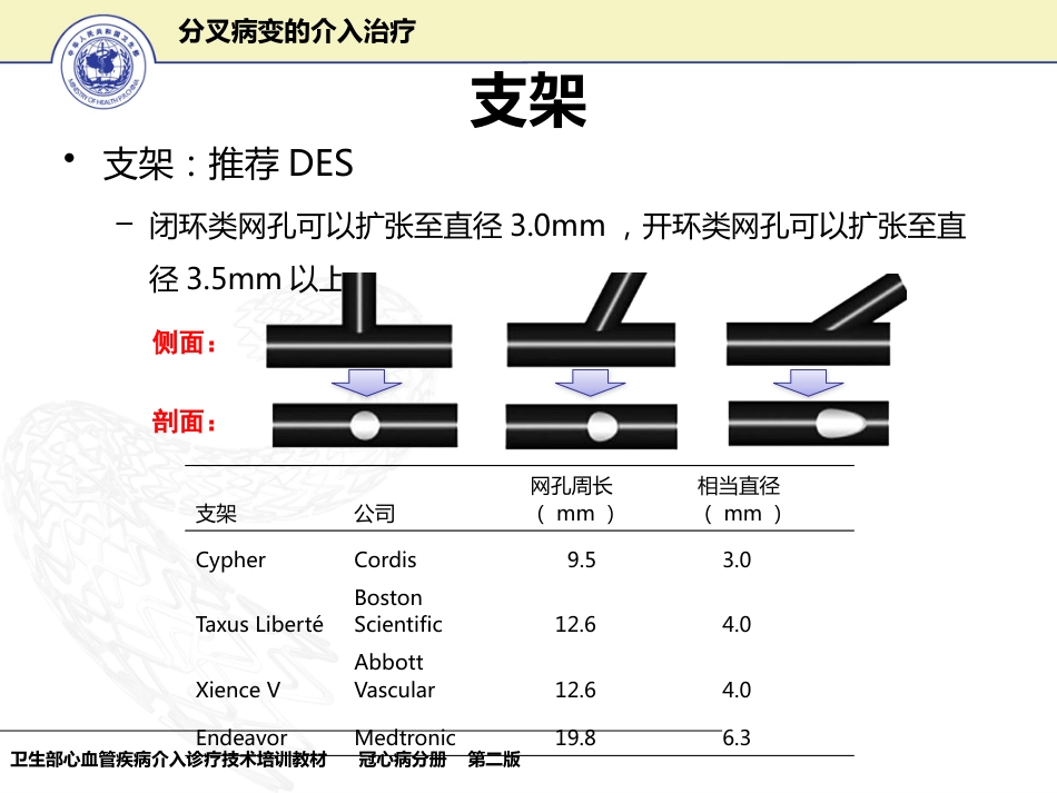 分叉病变的介入治疗_第14页