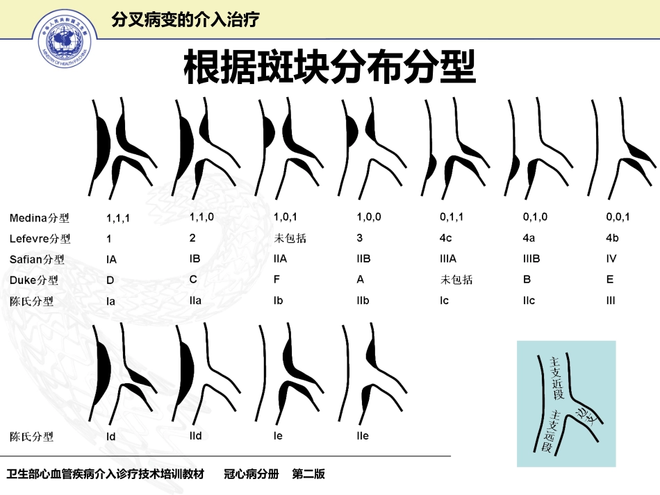 分叉病变的介入治疗_第8页