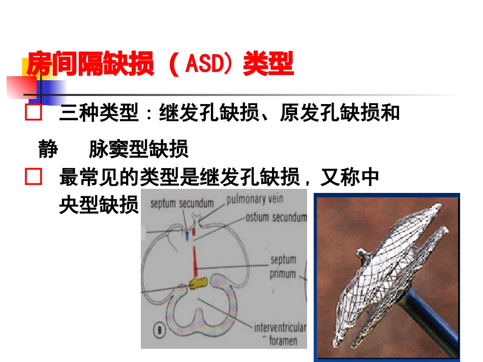 不常用的心脏介入治疗_第10页