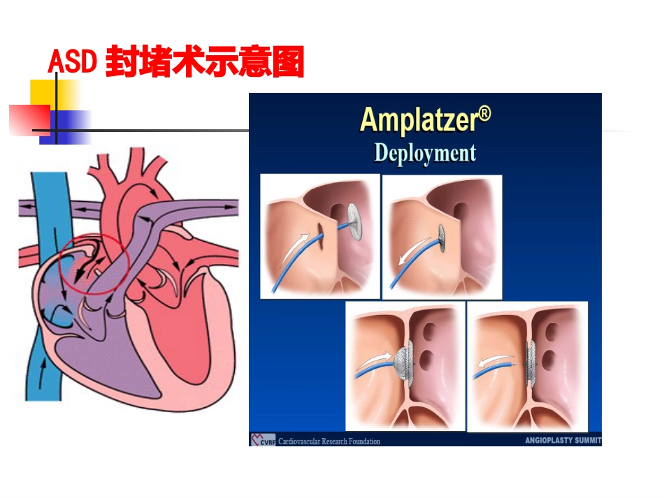 不常用的心脏介入治疗_第11页