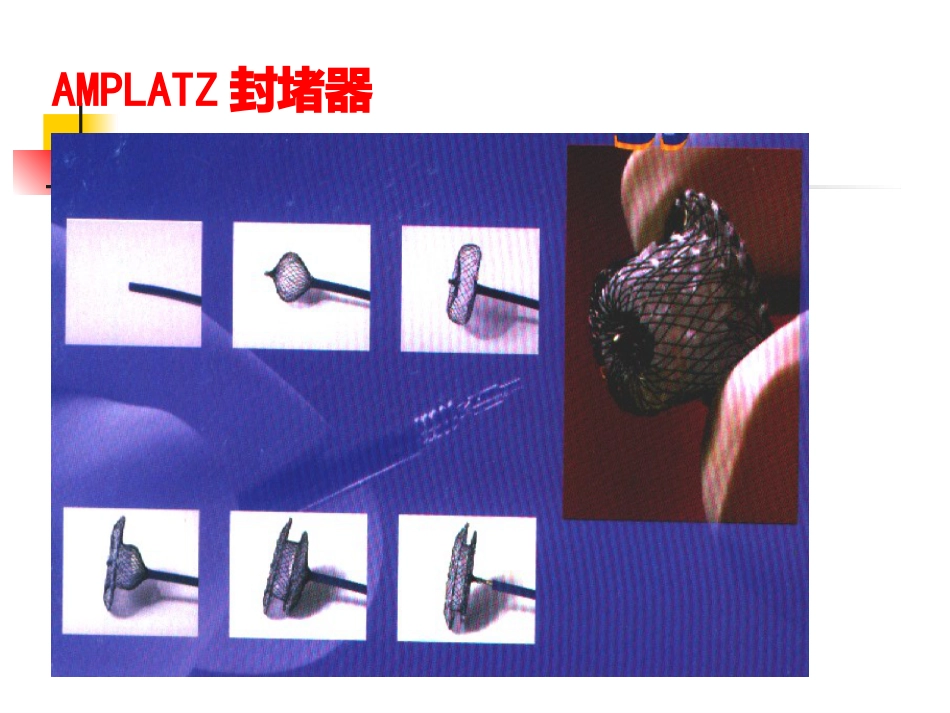 不常用的心脏介入治疗_第14页