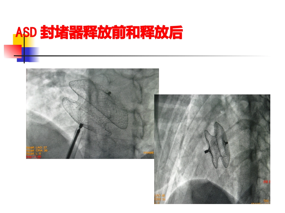 不常用的心脏介入治疗_第15页