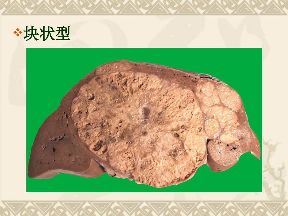 肝癌ppt_第10页
