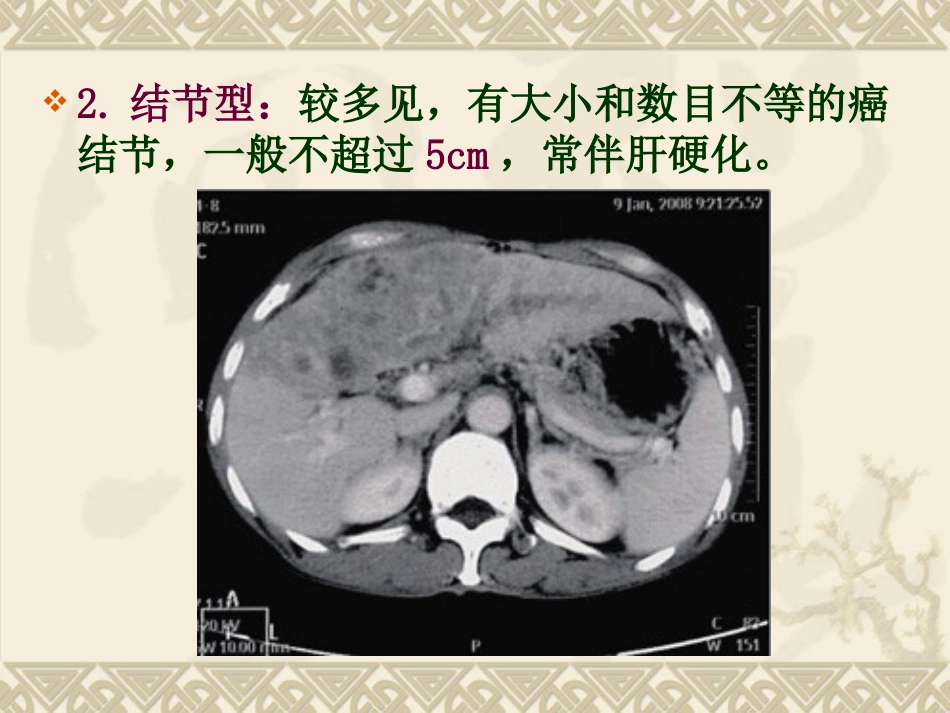 肝癌ppt_第11页