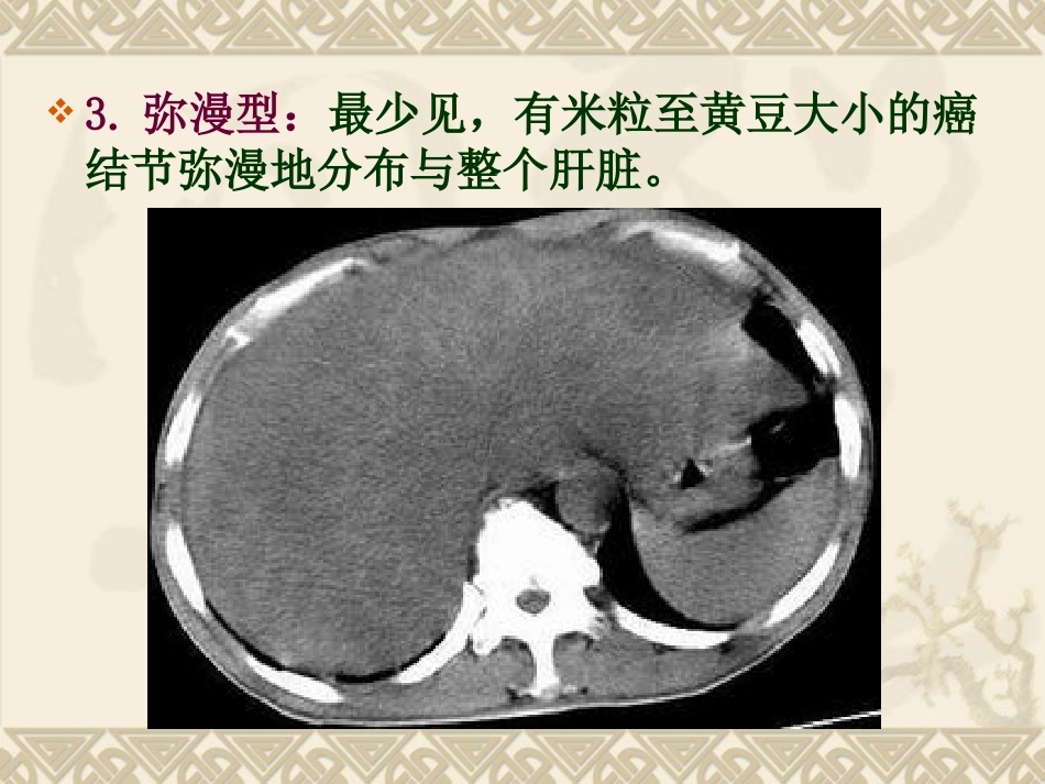 肝癌ppt_第13页