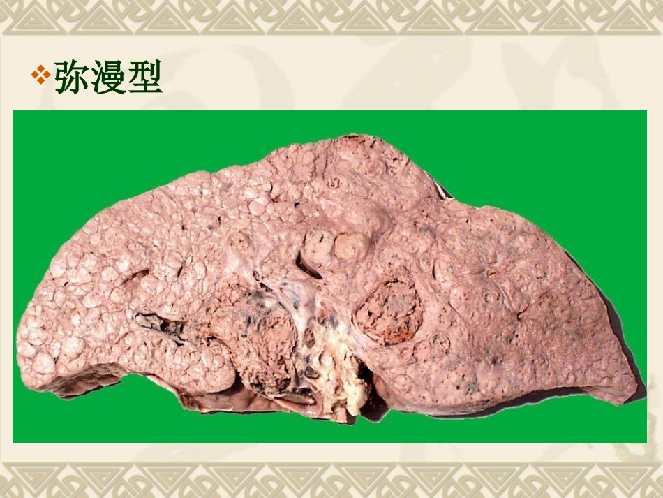 肝癌ppt_第14页