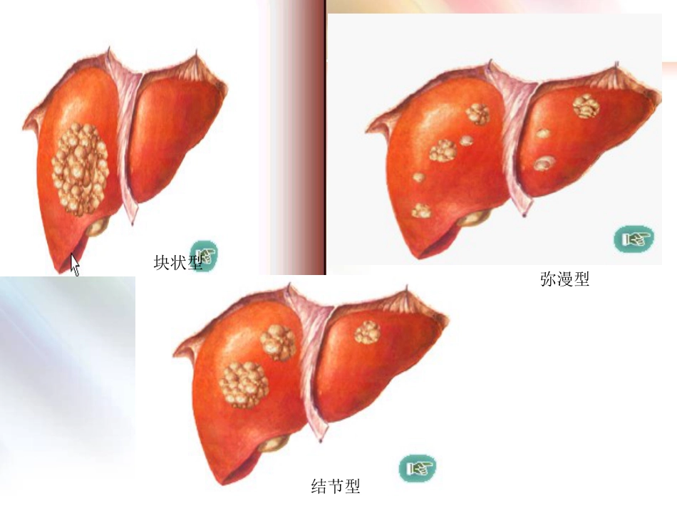 肝癌简介_第11页