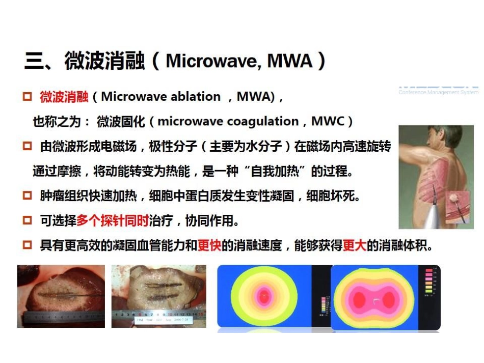 肝癌的几种消融治疗方法的比较_第11页