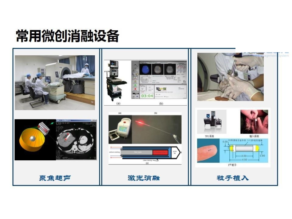 肝癌的几种消融治疗方法的比较_第5页