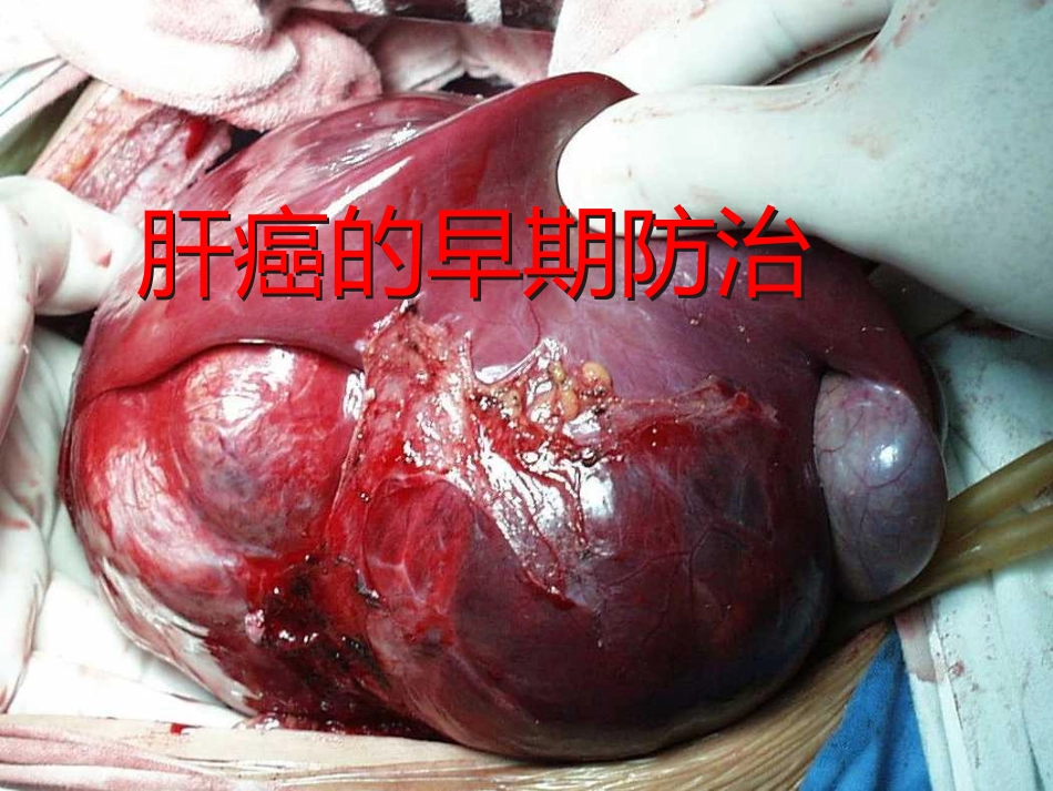 肝癌的早期防治_第1页