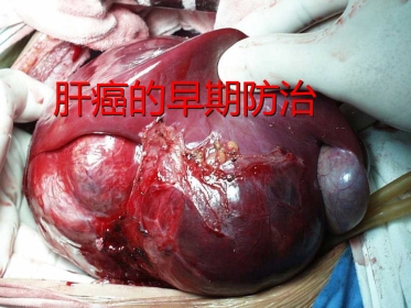 肝癌的早期防治