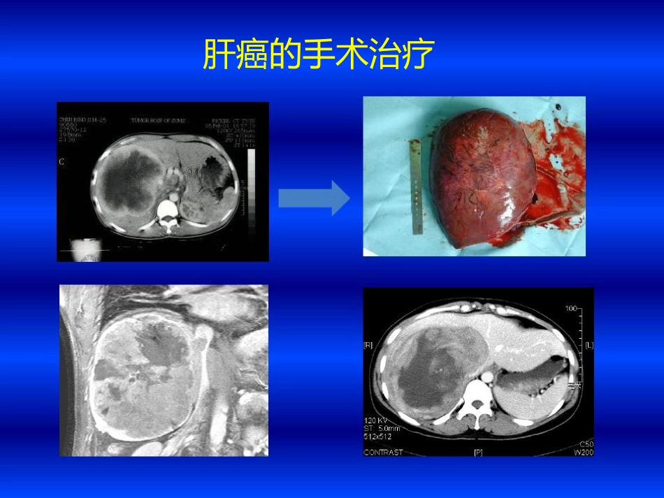 肝癌MDT与联合治疗策略_第3页