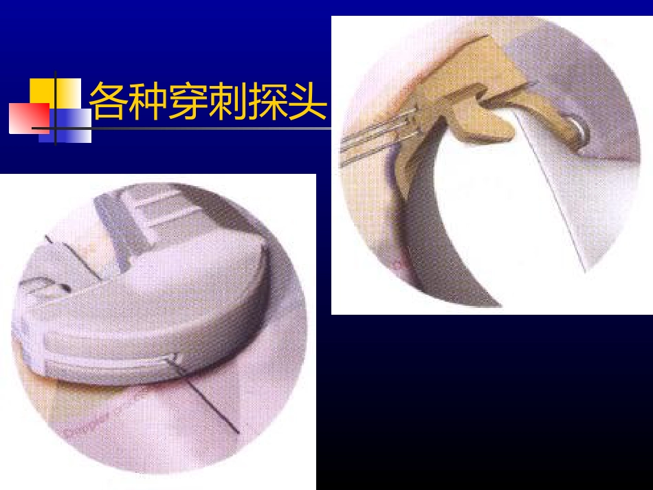超声介入-US_第11页