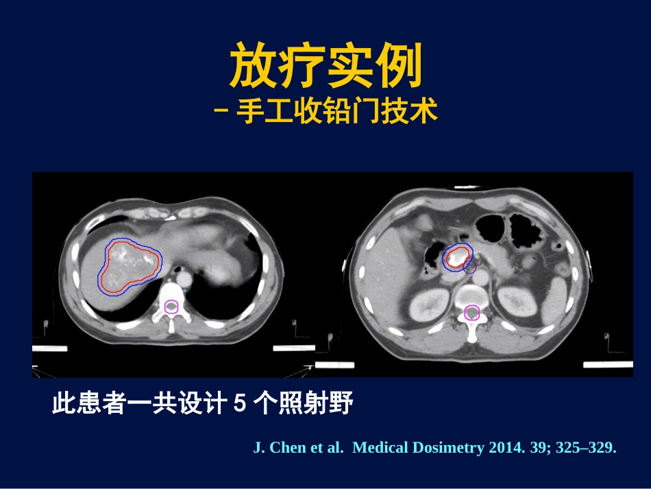 肝癌放疗新证据_第14页