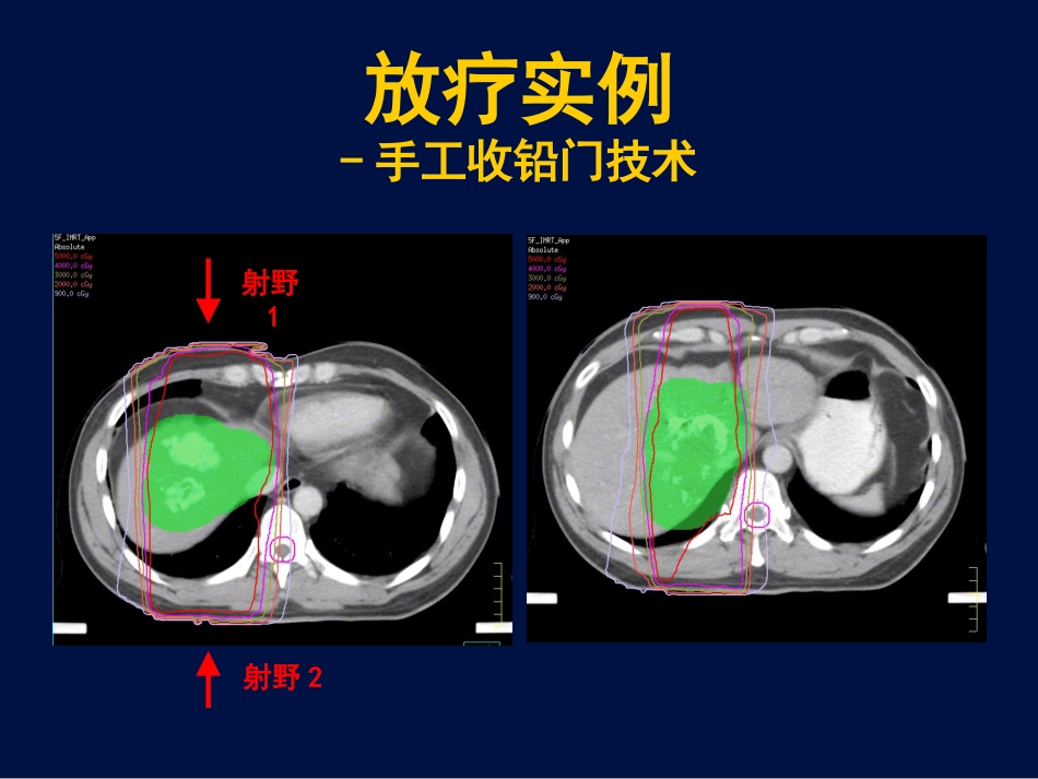 肝癌放疗新证据_第15页