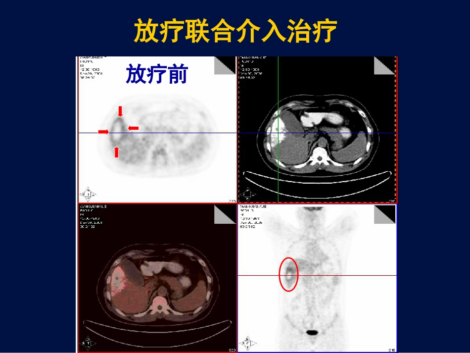 肝癌放疗新证据_第6页