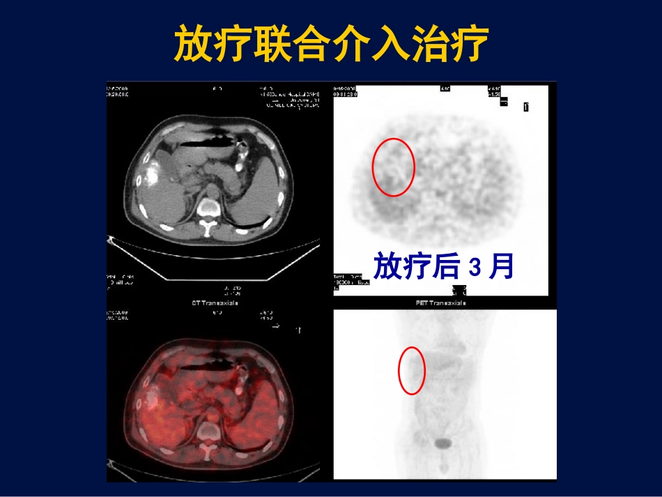 肝癌放疗新证据_第7页